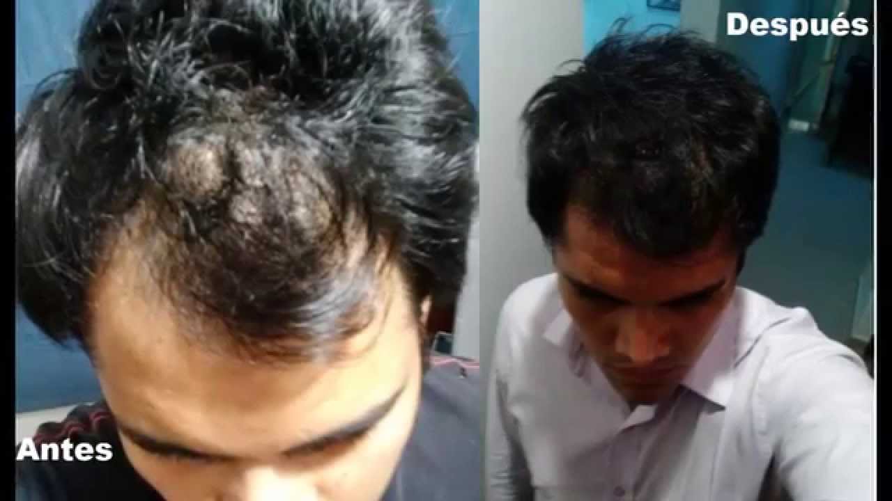 La mostaza al tratamiento de la caída de los cabello