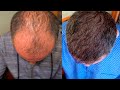 Трансплантация волос FUE. До и После операции | Hair transplant Month by Month.