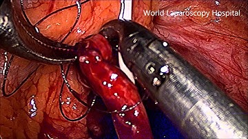 Laparoscopic Pyeloplasty at World Laparoscopy Hosoital