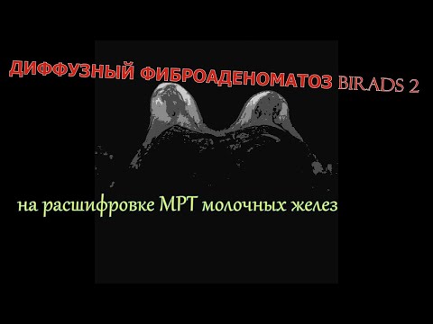 ДИФФУЗНЫЙ ФИБРОАДЕНОМАТОЗ молочных желез BiRADS 2 на расшифровке МРТ