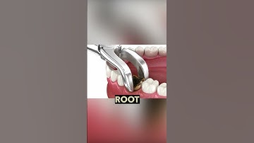 Cavities Explained: What Really Happens If You Don’t Treat Tooth Decay