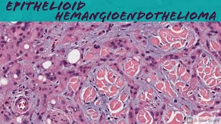 Epithelioid Hemangioendothelioma 101 (for Pathologists and Dermatologists) screenshot 4