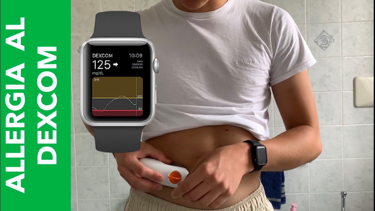 ALLERGIA AL DEXCOM (G4-G5-G6) - YouTube