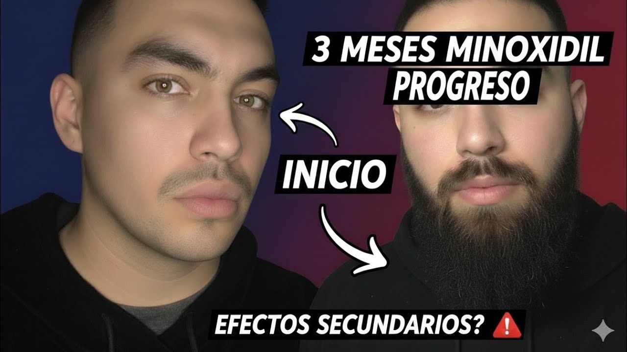 3 meses de MINOXIDIL para la Barba🤯.¿me funcionó?🤡 | comienzan los efectos secundarios 🤕😱☠️