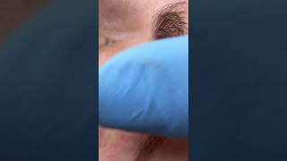 Dangers of microblading long term damage scars caused by microblading