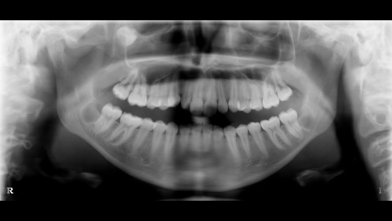 Zahn ziehen nach kieferknochenentzündung Zahnschmerzen nach