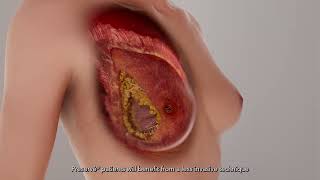 How Preserve Enhances Breast Augmentation with Less Invasiveness
