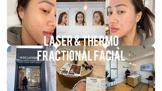 First laser & Thermo Fractional facial experience at Skin Laundry I Whats Thermo Fractional facial