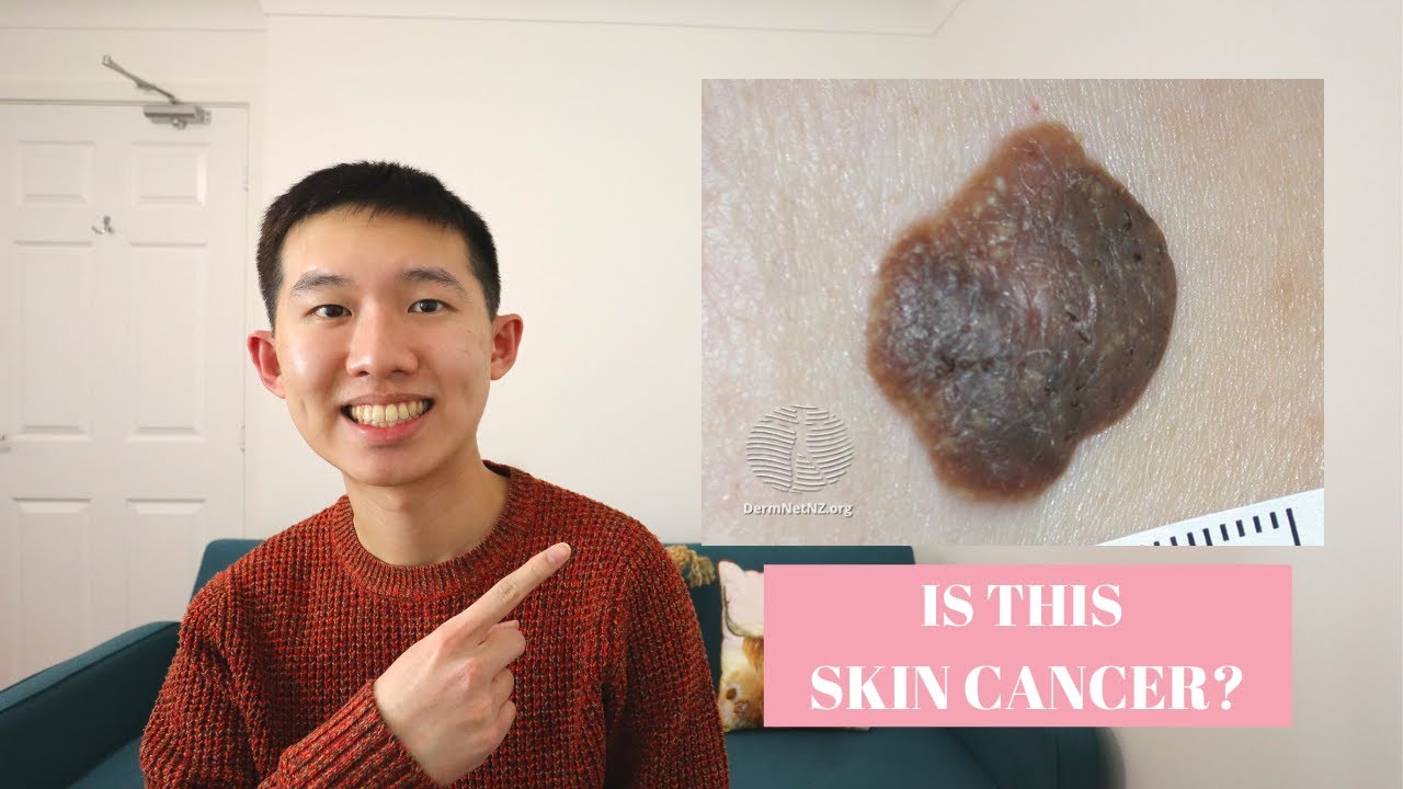 IS THIS A SKIN CANCER?