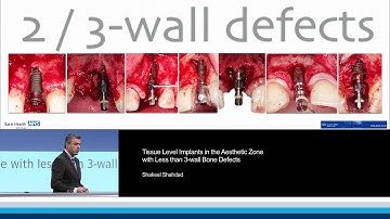 Tissue Level Implants in the Aesthetic Zone with Less than 3-wall Bone Defects | Shakeel Shahdad