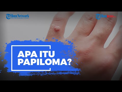 Video: Papiloma Di Wajah: Foto, Penyebab Penampilan, Pengobatan