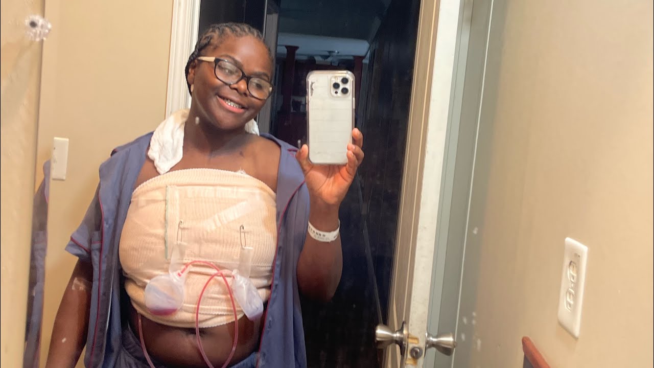 Breast Reduction 2 Month Post Op DD To B Cup YouTube