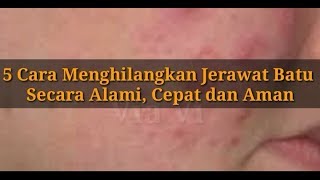 Cara Menghilangkan Jerawat Batu Secara Alami, Cepat Dan Aman