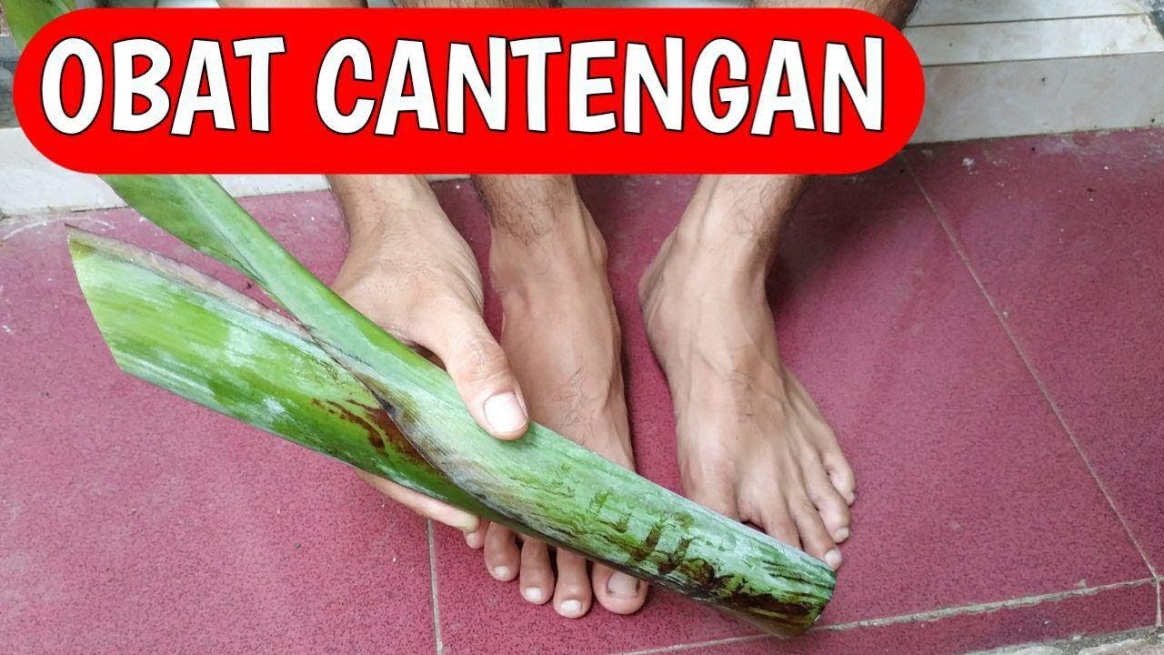 Cara mengobati Cantengan di kaki