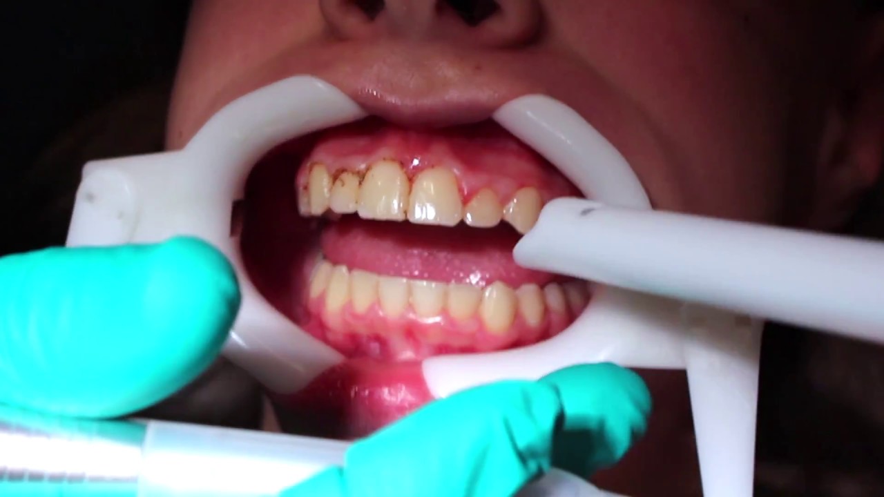 Gingival Recontouring (Reshaping the gum tissue with a laser) YouTube