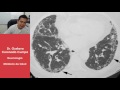 Fibrosis Pulmonar Idiopática