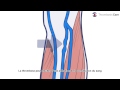 La thrombose veineuse profonde