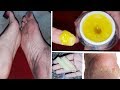 मोमबत्ती से 5 मिनट में फटी एङिया ठीक करे हमेशा के लिए|Get rid of cracked heels|Feet brightening