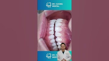 Hàm răng sau khi niềng sẽ như thế nào? |Dr Cường Official