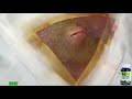 Dr. Gilmore&#39;s Angry Melon Cyst!  Dr. John Gilmore