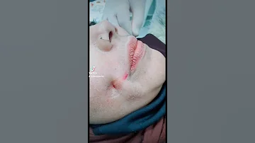 عمل غمازات في تركيا اسطنبول Dimple 