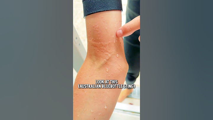 😱STUNG ! OUCH!🔥 Hot Shower vs. Bluebottle Sting! 😨 Will This REALLY Work?! 🇦🇺 #shorts