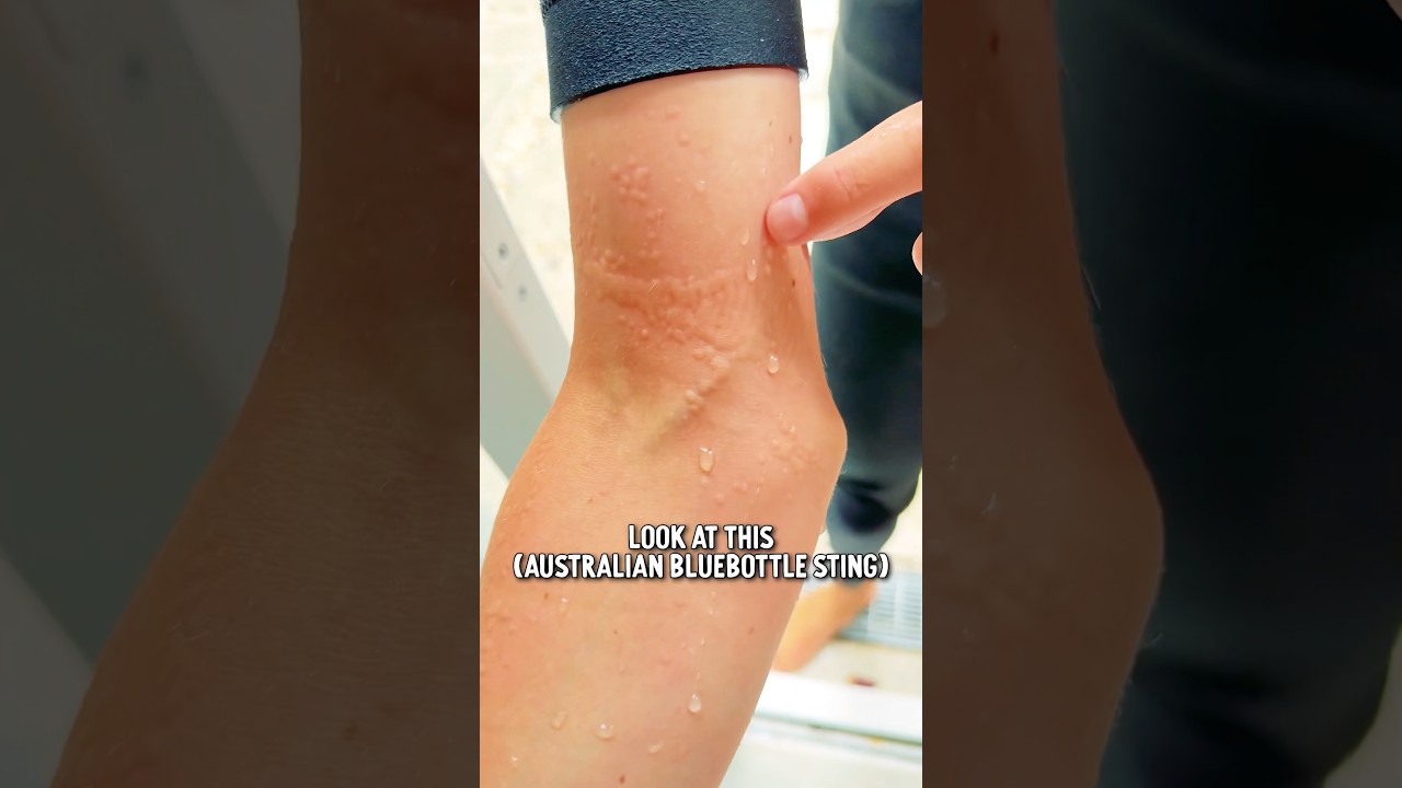 😱STUNG ! OUCH!🔥 Hot Shower vs. Bluebottle Sting! 😨 Will This REALLY Work?! 🇦🇺 