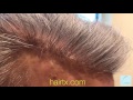 Dallas FUE Hair Transplant Correction Video Close Up