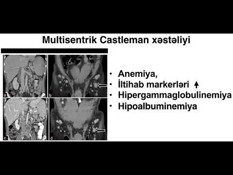 Video: Castleman xəstəliyinə necə diaqnoz qoymaq olar: 12 addım (şəkillərlə)