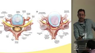 Management of Cervical Stenosis - Charles A. Sansur, MD