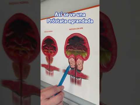 Próstata Agrandada #saludmasculina