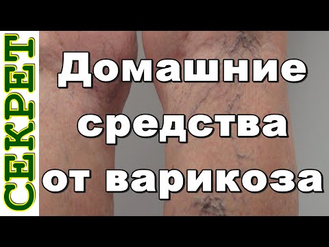 Народные средства от варикозного расширения вен