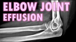 Elbow Joint Effusion - Sail Sign #trauma #radiology #bones