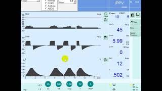 Continuous Mandatory Ventilation (CMV): Settings and Adjustments