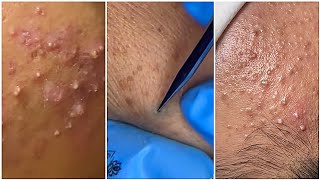 Extremely satisfying blackheads exfoliation, for blackheads and pimples TikTok compilation : pt. 6 :