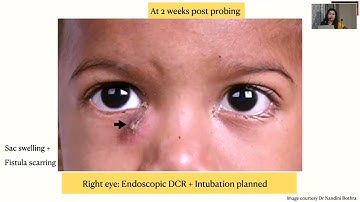 AIOCMTC4 2025 GP34 T Dr Shikha Taneja Adult and Paediatric Acute Dacryocystitis  The Changing Trend