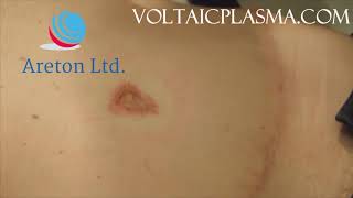 Post Surgical Umbilical Scar Removal Slovenian And English Post Surgical Umbilical Scar Removal Slovenian And English
