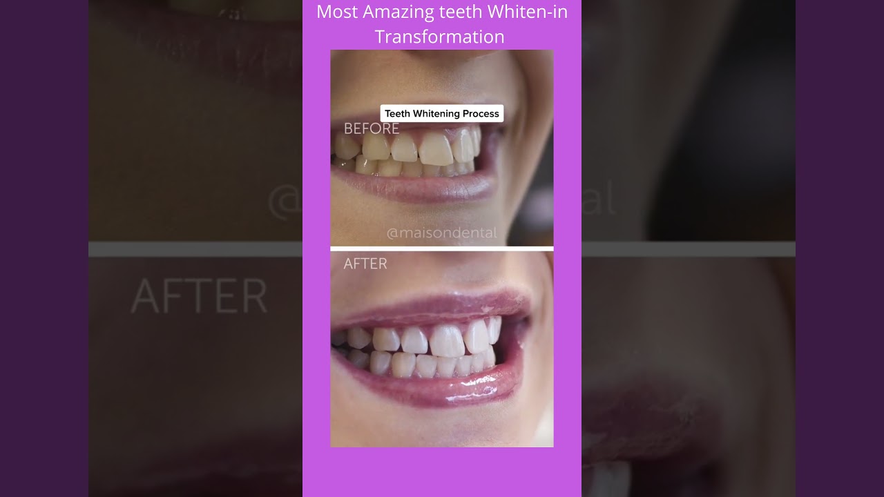 Most Amazing Teeth Whiten-in Transformation/Motivation by Masondental