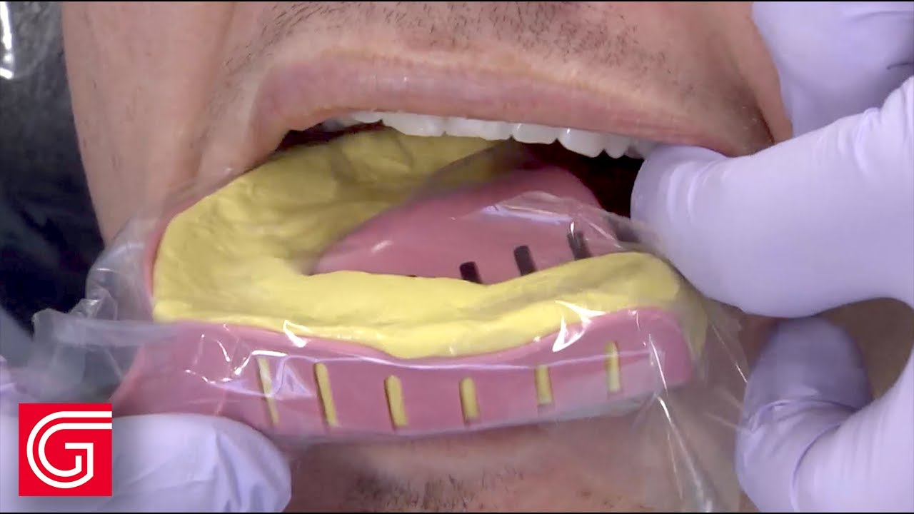 Un Consejo para IMPRESIONES de Arcada Completa