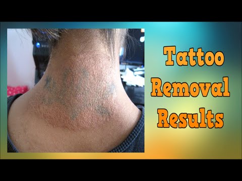 Tattoo Removal Results, Best Laser Tattoo Removal, Is ...