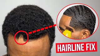 how to tell if you’re losing your hairline