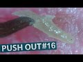 #16 Push Out(Squeezing)Blackheads Close up | ピンセットで角栓を押し出し除去