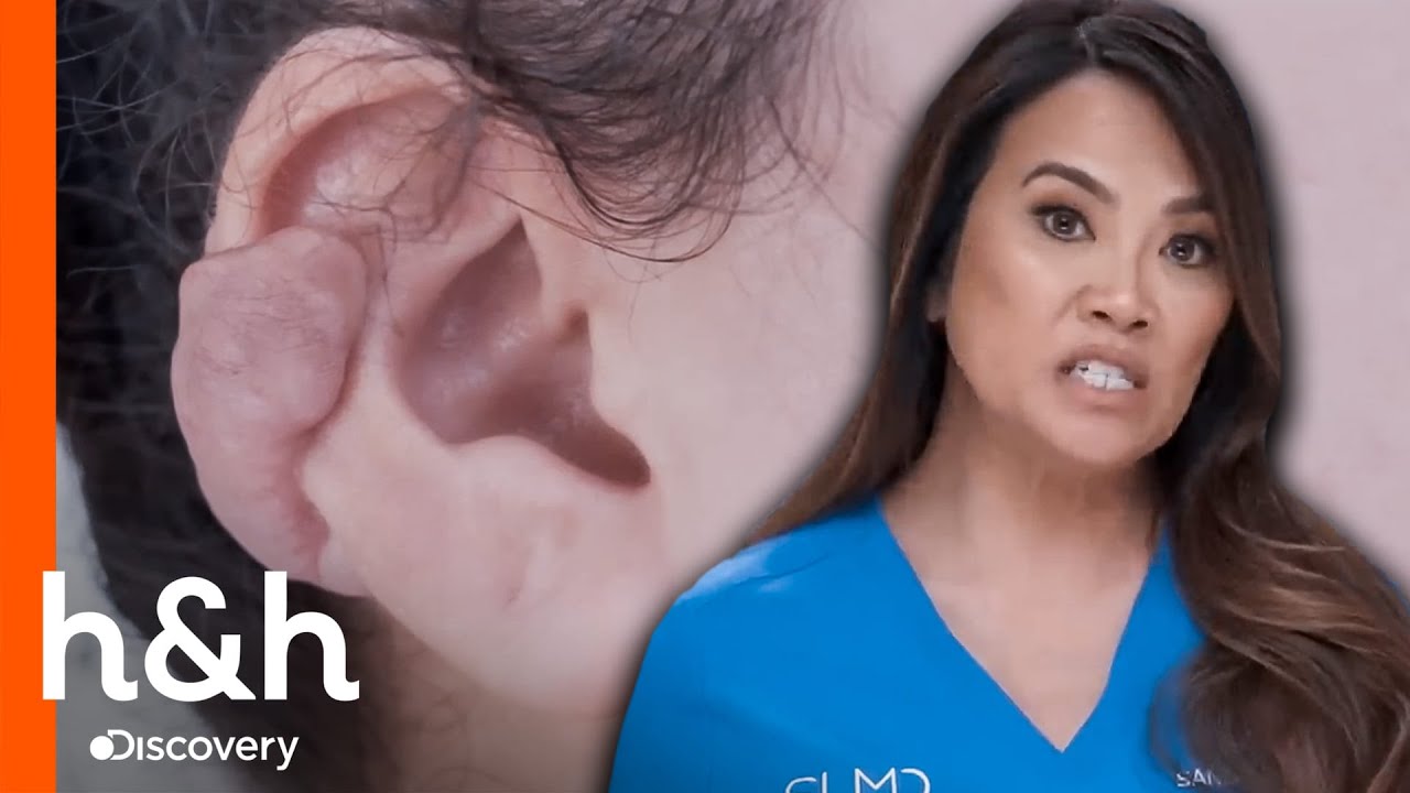 As perfurações nas orelhas podem provocar queloides | Dra. Sandra Lee: A Rainha dos Cravos