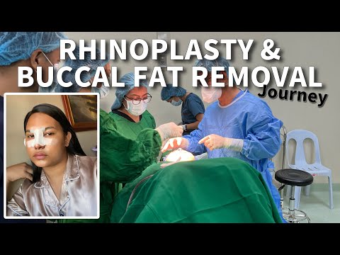 MY RHINOPLASTY AND