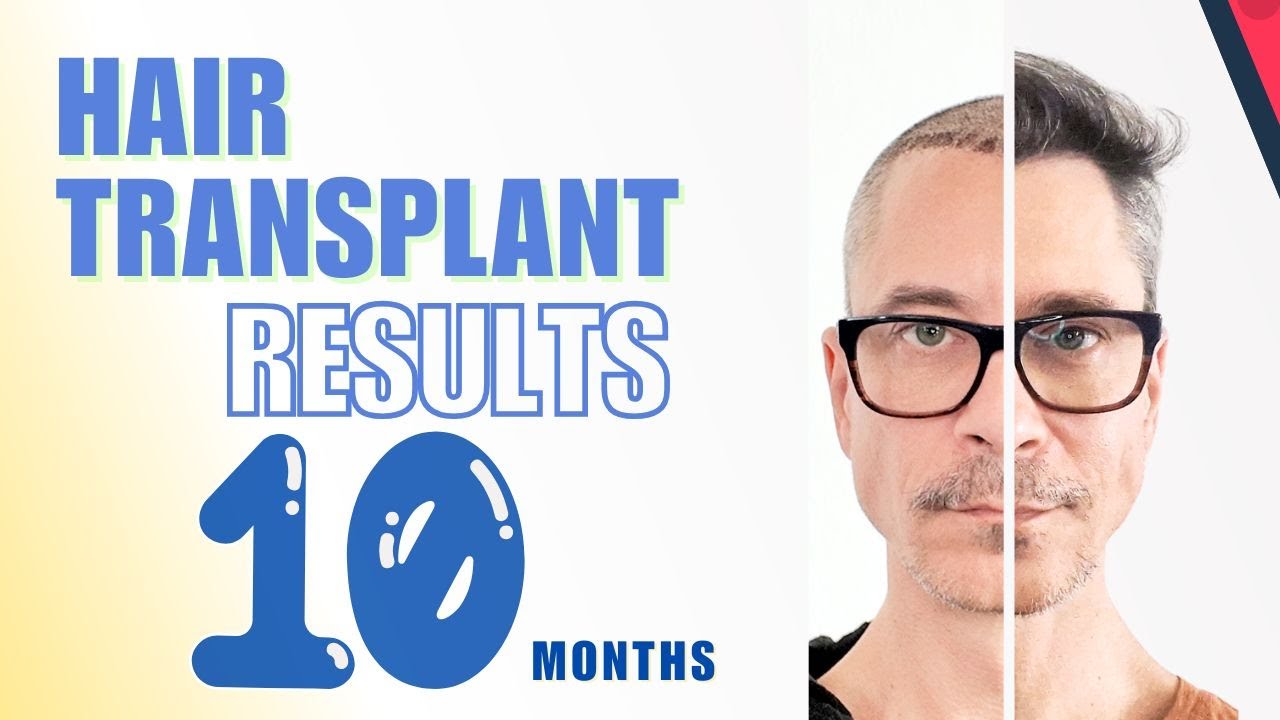 Чему я научилась, сделав пересадку волос в Турции | Клиника Cosmedica, Стамбул