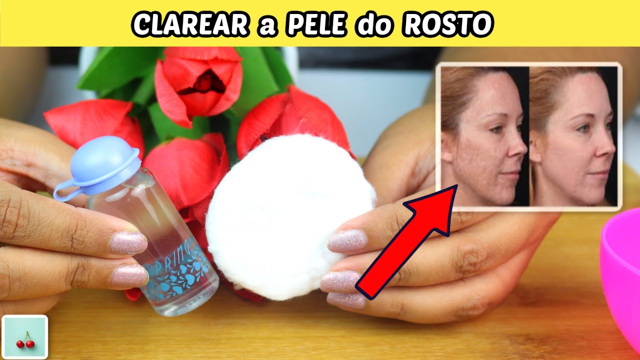 Receita Caseira Como Clarear a Pele do Rosto Melasma Manchas na Pele ...