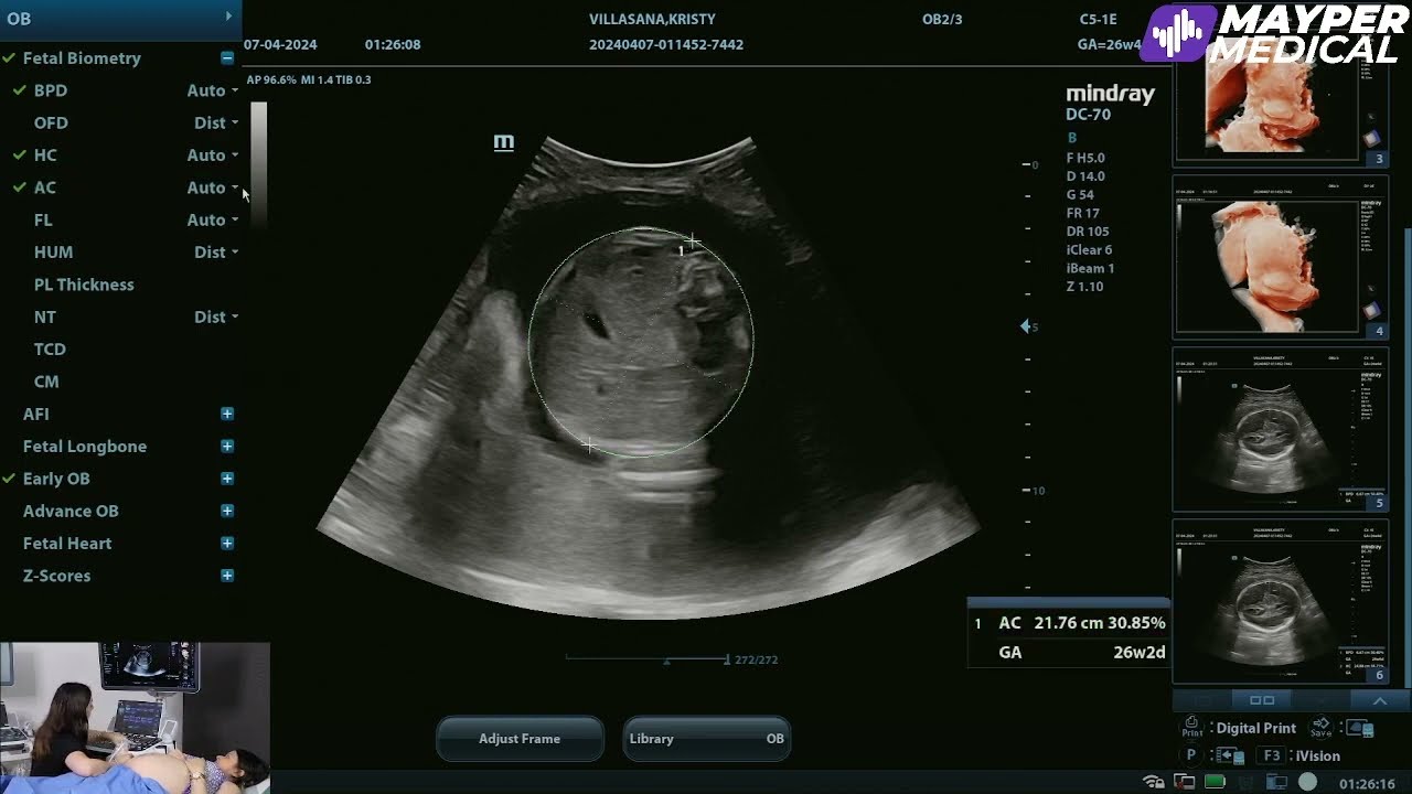 Demo de nuestro ultrasonido Mindray DC70
