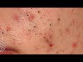 Most Satifying Video Blackhead Removal ,Acne New Video 2025,  Extration Tools
