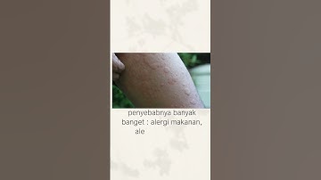 Thumbnail of biduran, bentol- bentol. kenapa ya