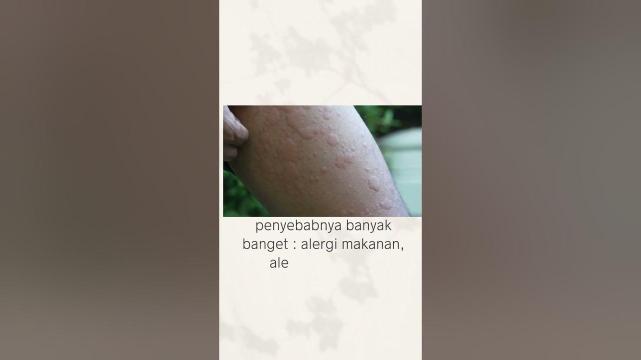 biduran, bentol- bentol. kenapa ya